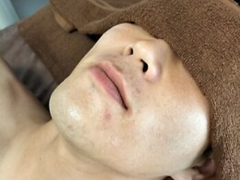 コハ(koha)の写真/【メンズが髭を剃る時代は終わり、脱毛する時代へ】青髭や髭剃り負けによる肌荒れにお悩みの方必見☆