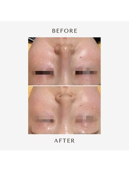 ヒヨリ(hiyori)/《before/after》毛穴洗浄