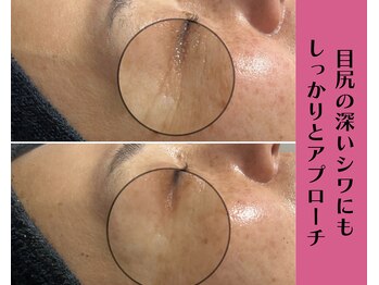 ヴィータ(VITA)/陶肌トリートメント