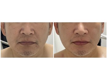 クロッシュ(Cloche)/プラズマ美肌ケア