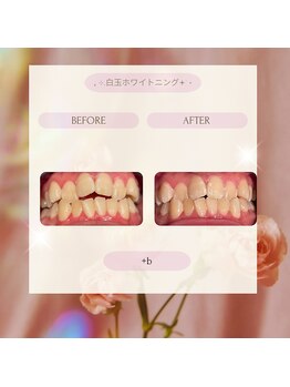 プラスビーセルフ(+b self)/ホワイトニングビフォーアフター