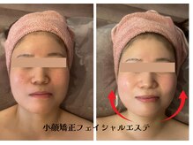 フェイシャルでむくみ、たるみ、スッキリ、フェイストーンアップ