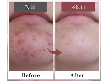 フルリール/【ニキビケアプロテクション】