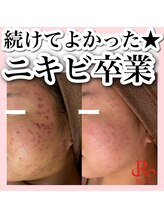 アルムダアクア 天王寺店(Aleumda AQUA)/大阪/天王寺/ハーブピーリング