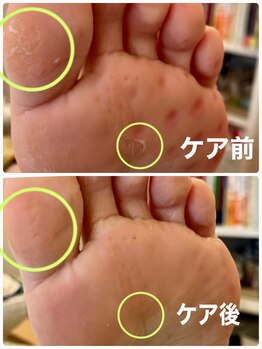 ネイルサロンアンドスクール シーグリーン(SEAGREEN)/足裏の魚の目やタコ