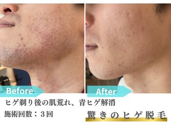 トレース/ヒゲ脱毛の効果