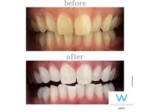ホワイトニングショップ 高崎店/ビフォーアフターホワイトニング
