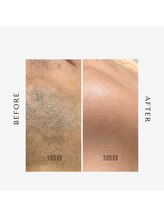 エミナル(EMINAL)/メンズ脱毛