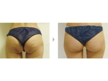 Nビューティー/最新RFサーモシェイプオーパス