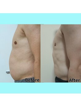 ホワイトビューティーラボ(White Beauty Lab)/脂肪冷却腹部