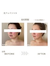 サロン エイトミー(salon 83)/光フェイシャル/before→after