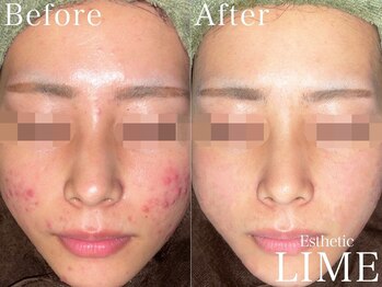 ライム 心斎橋(LIME)/ ハーブピーリング｜毛穴/ニキビ