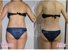 グラウディア 恵比寿/痩身/筋膜リリース/インディバ超