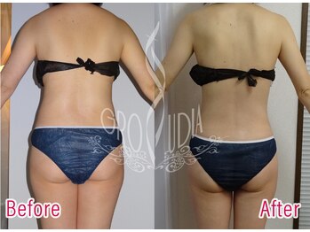 グラウディア 恵比寿/痩身/筋膜リリース/インディバ超