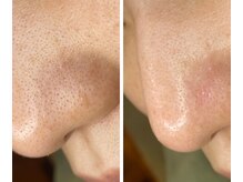 サイ(Sai)/before⇒after