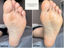 レーヴ アヴニール(Reve Avenir)/S-PLANING韓国式足裏角質ケア