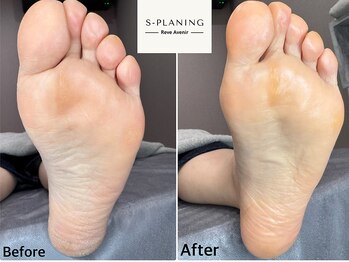 レーヴ アヴニール(Reve Avenir)/S-PLANING韓国式足裏角質ケア