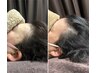 【育毛促進鍼】女性:分け目|立ち上がり対策スカルプ鍼18,700→16,000