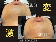 ラピスダズル(LAPIS DAZZLE)/髭脱毛☆途中経過