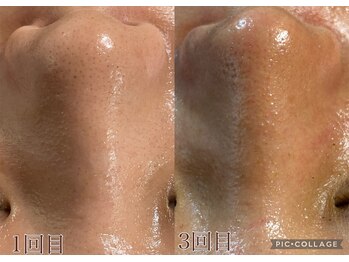 ナニミー(Nani.me)/ハイドラ＋EMS