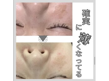 じゅえる/シミケア9回の効果 次へ→