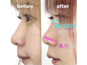 ラプリ 大宮店(Raplit)/隆鼻＋輪郭矯正40分10回