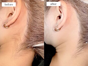 エムドット(m.)/うなじワックス脱毛