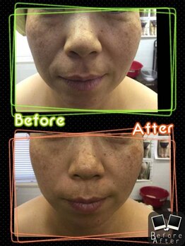 ビューティー ボディ スラ(Beauty body)/毛穴、ピーリング、ほうれい線