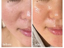 ココ(COCO)/ハーブピーリング/REVI/高知