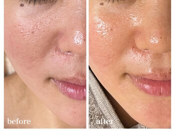 ココ(COCO)/ハーブピーリング/REVI/高知