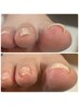 巻き爪のお悩みに　ケア＆ジェル補正コース◎