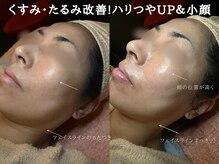 シワ/くすみ改善!水光美肌♪フォトギャラリーでもご紹介してます