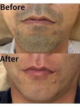 レイズ(Reyz)/メンズ脱毛/全身脱毛/VIO