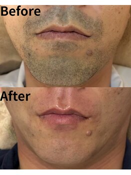 レイズ(Reyz)/熊本Reyz・ヒゲ脱毛施術実績