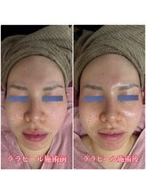 リエル(Liel)/不動の人気「ララピール」