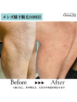 オリオンドットエスツー(Orion.S2)/【Before→After】