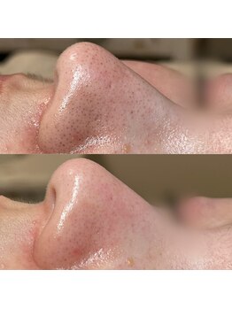 フレーズ(fraise)/毛穴エクストラクション