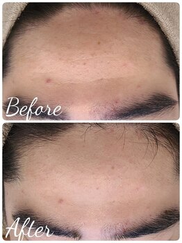 サロンド シェリー(Salon de Cherie)/ハーブピーリング