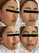 レアレアケー(Lea Lea_K)/キッズ 顔 ワックス脱毛