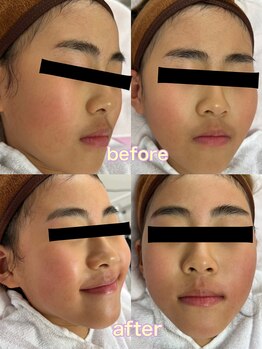 レアレアケー(Lea Lea_K)/キッズ 顔 ワックス脱毛