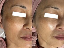 ティアラッシュ(TiaLash)/低周波を使用したシミケア