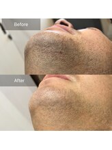 ミホノ 和泉中央店(mihono)/顔ヒゲ脱毛