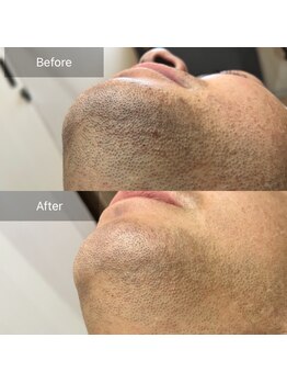 ミホノ 和泉中央店(mihono)/顔ヒゲ脱毛