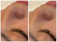 リノセス(Linocess)/毛穴の詰まり改善