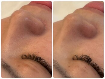 リノセス(Linocess)/毛穴の詰まり改善