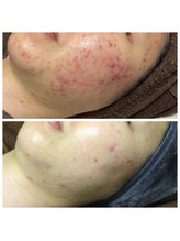 リラーナ(Re rana)/大人ニキビケア♪