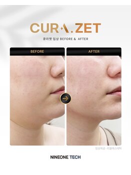 ミロク(369)/韓国発最新脂肪分解注入