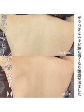 エムラボ 麻布十番店(M LABO)/背中のハーブピーリング