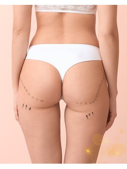 リガーラ(Re gala)の写真/悩める太もも・ヒップケアに！女性国家資格者施術で隠すから見せるヒップへ♪