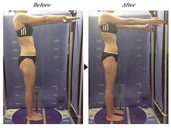 ビューティークリニックコダマ 延岡店/【1ヶ月コース】M.S様(25歳)